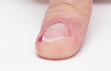 Male finger with torn burr and nail with blood, nail biting, white background, injury, copy space, macro