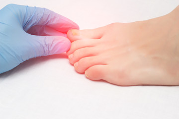Doctor examines a sore toe infected with fungal infection, close-up, onychomycosis, medical