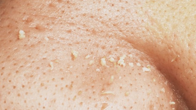 non groomed and ditry male skin with acnes, macro