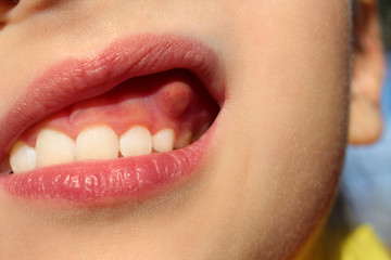     Swelling on gums the child.