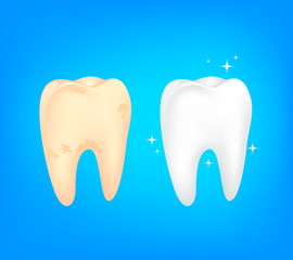 Dirty and clean tooth comparision on blue background.  Teeth Whitening. Dental care Concept. Oral Care, teeth restoration. Yellow and white teeth.