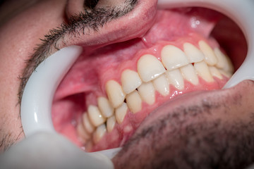 Dentes