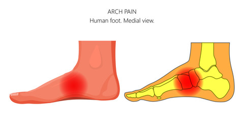 Vector illustration of unhealthy human foot with arch pain or injury.  Medial or side view.  For advertising and other medical publications.