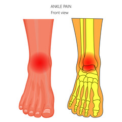 Vector illustration of unhealthy human foot with ankle joint pain or injury.  Front view.  For advertising and other medical publications