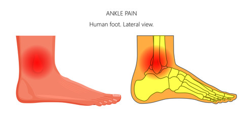 Vector illustration of unhealthy human foot with ankle joint pain or injury. Lateral or side view.  For advertising and other medical publications