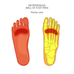 Vector illustration of forefoot pain, metatarsalgia symptom, tenderness in the balls of metatarsal bones of the foot. For advertising and other medical publications