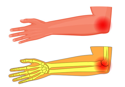 Vector illustration of a human elbow joint with a pain or injury.