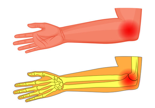 Vector illustration of a human elbow joint with a pain or injury. Medial view. For advertising, medical publications