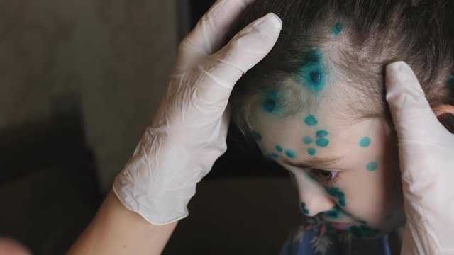 Female doctor in gloves examines the girl's face is sick with pox.