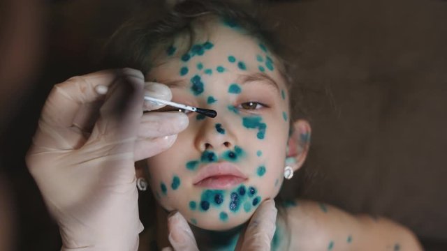 Varicella. Woman doctor treats antiseptic ointment blisters from chicken pox on the face of a little girl.