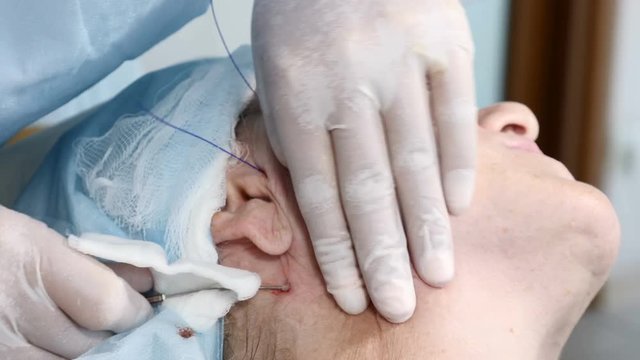 Aged woman getting facial rejuvenation. Face skin lifting and tightening in beauty clinic. Beautician in gloves making cosmetology antiaging procedure. 4k
