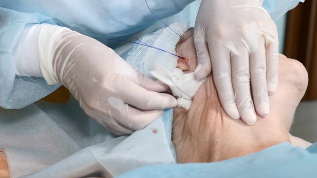 Painful beauty procedure to hide signs of aging. Senior female patient getting face skin lifting with medical threads. 4k