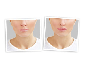 Beauty injections.Concept of rejuvenation.Lip augmentation