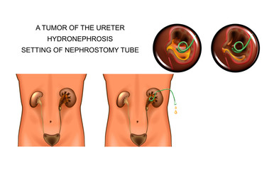 a tumor of the ureter. hydronephrosis. setting of nephrostomy tube