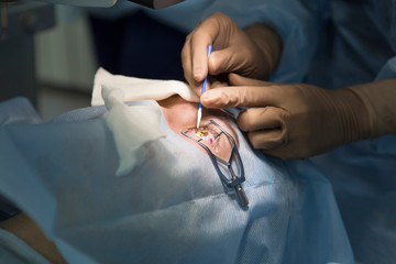 Laser surgery for vision correction