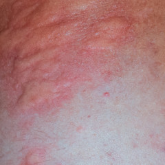 Allergy skin back and sides. Allergic reactions on the skin in t