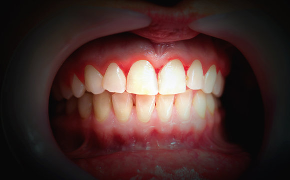 Mouth with bleeding gums on a dark background