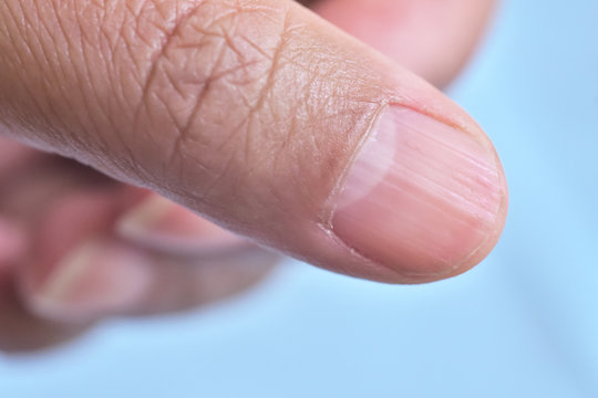 For years my fingernail has grown this white line ending in a soft  spot/indent : r/mildlyinteresting