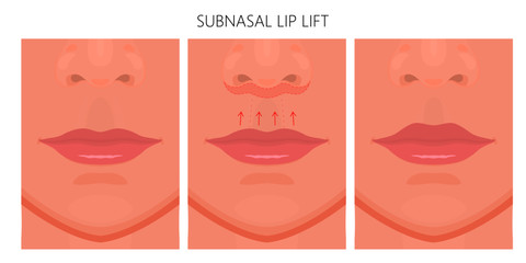 Vector illustration. Subnasal lip lift steps on women face, after procedure. Close up view. For advertising of medicinal, cosmetic and plastic surgery and procedures