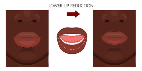 Vector illustration. African American lower lip reduction before, after procedure. Close up view. For advertising of cosmetic plastic procedures; for medical and beauty publications