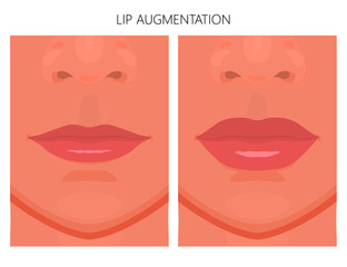 Vector illustration. Lips augmentation on women face, after procedure. Close up view. For advertising of medicinal, pharmacy products, cream, lotion, cosmetic and plastic procedures