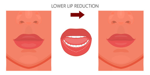 Vector illustration. Lower  lip reduction before, after procedure. Close up view. For advertising of cosmetic plastic procedures; for medical and beauty publications
