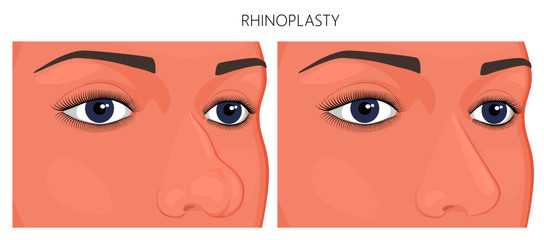 Vector illustration. A human nose before, after aesthetic plastic surgery - rhinoplasty (nose job). Close up view. For advertising, medical and beauty publications