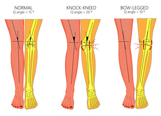 Vector illustration diagram. Shapes of human legs. Normal and curved legs. Knock knees. Bowed legs. Genu valgum and genu varum.  For advertising, medical publications - obrazy, fototapety, plakaty