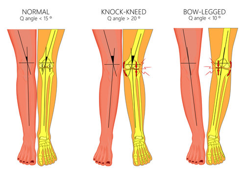 bow legged people