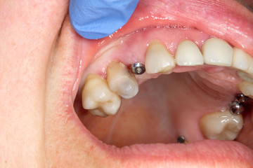 Close-up dental implant wort patient in a dental clinic during treatment. The concept of surgical aesthetic dentistry