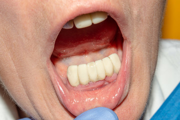 dental restoration of rotten roots of the teeth with ceramic crowns. cast posts dentistry