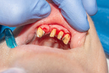 Obraz premium dental restoration of rotten roots of the teeth with ceramic crowns. cast posts dentistry