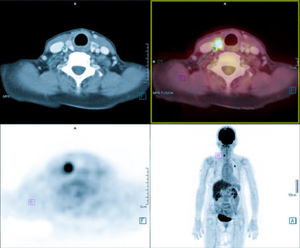 PET/CT of thyroid gland is a valuable imaging test, in the appropriate clinical context, for the management of thyroid cancers.