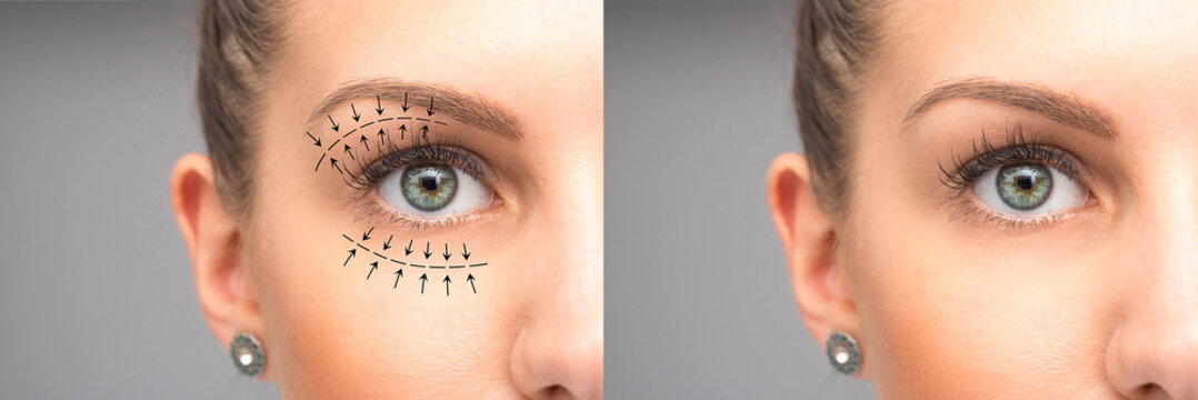 Female eyes before and after blepharoplasty
