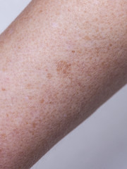 Naklejka premium Skin complexion discoloration, hyperpigmentation close up