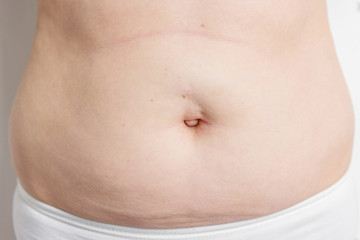 Excessive belly fat on white background. Umbilical hernia.