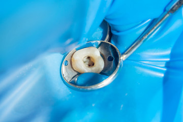 dental restoration of rotten roots of the teeth with ceramic crowns. cast posts dentistry