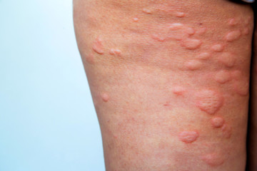 Fototapeta premium Skin rash in the legs