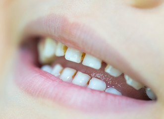 Fototapeta premium Six-year-old boy smiles, showing calf's teeth, mouth macro close-up
