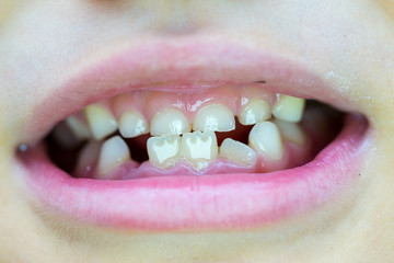 Obraz premium Six-year-old boy smiles, showing calf's teeth, mouth macro close-up