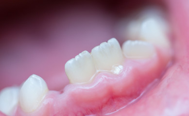 Six-year-old boy smiles, showing calf's teeth, mouth macro close-up