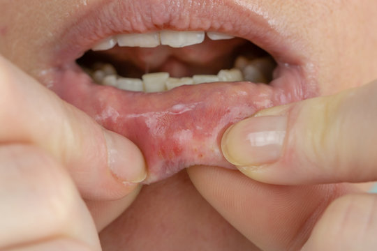 Woman with aphthae on lip