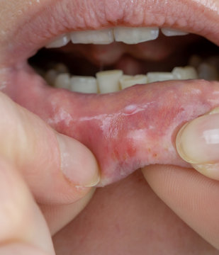 Woman with aphthae on lip