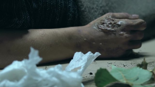 Homeless freezes in garbage, sores on hands of contagious incurable diseases