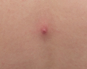 Naklejka premium Big red pimple abscess on the skin, close-up, pimple inflammation on the skin, copy space, infection
