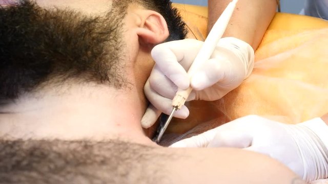 Doctor removing mole in surgical procedure by cutting it out with medical tools and equipment. Beauty concept. Papillomas removal. Close up. 4k