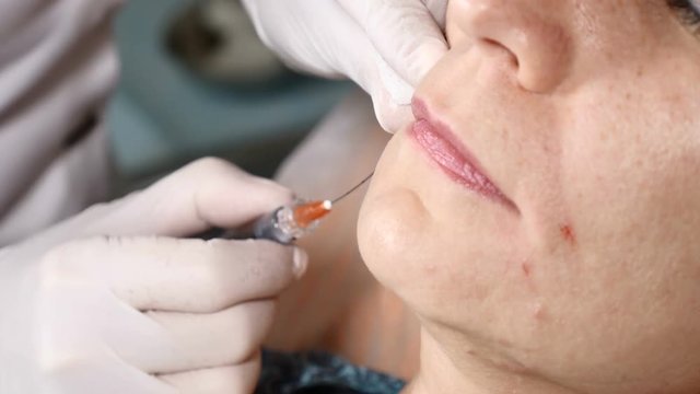 Injectional industry. Senior woman in beautician office. Syringe with botox in doctor hands. Face skin lifting. shot in 4k