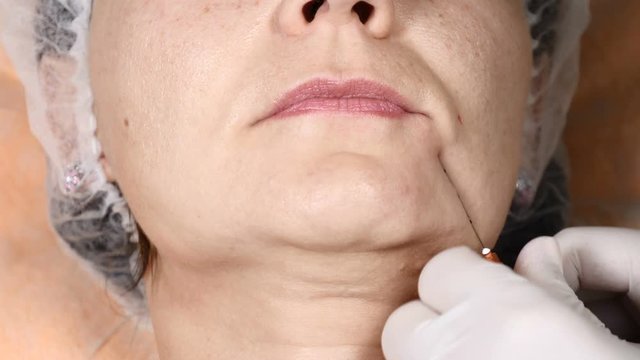 Top view on an aged woman in beauty clinic getting facial scin lifting. 4 k