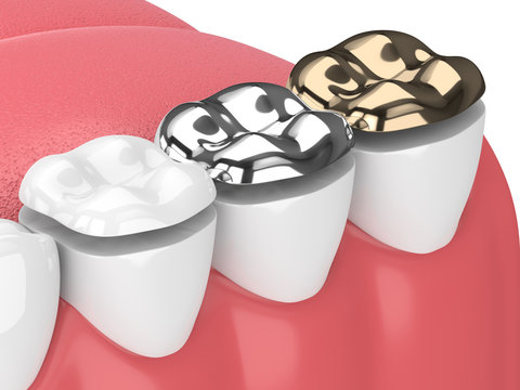 3d render of teeth with onlay