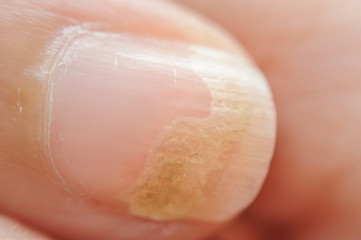 Fototapeta premium Onychomycosis or Fungal nail infection on forefinger